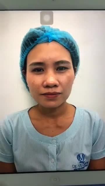 Nâng mũi cấu trúc chỉnh sửa mũi nhiều khuyết điểm