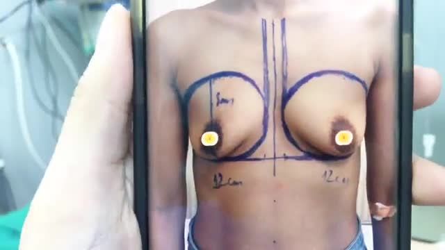 Nâng ngực nano chip