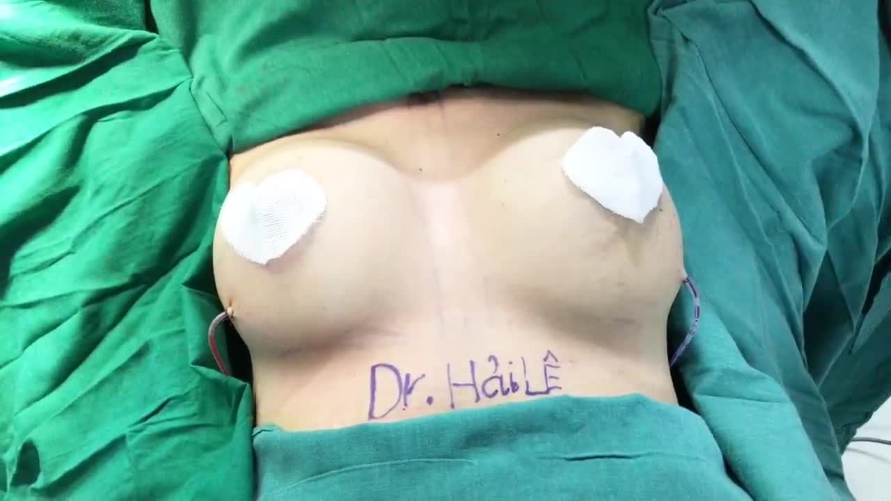 Nâng ngực Nano Chip size 300cc đi đường quầng ti