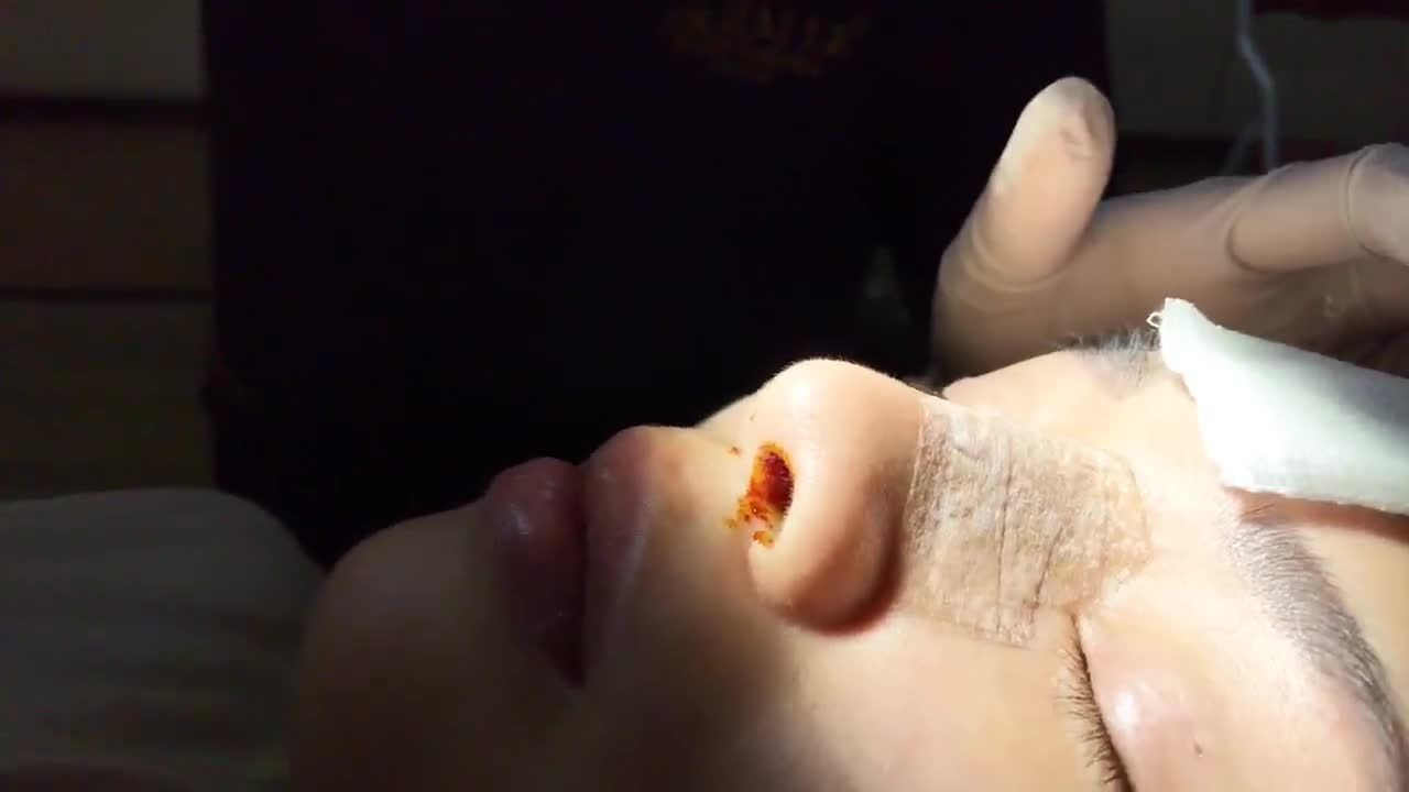 Cận cảnh cắt chỉ sau nâng mũi tại Dr Hải Lê