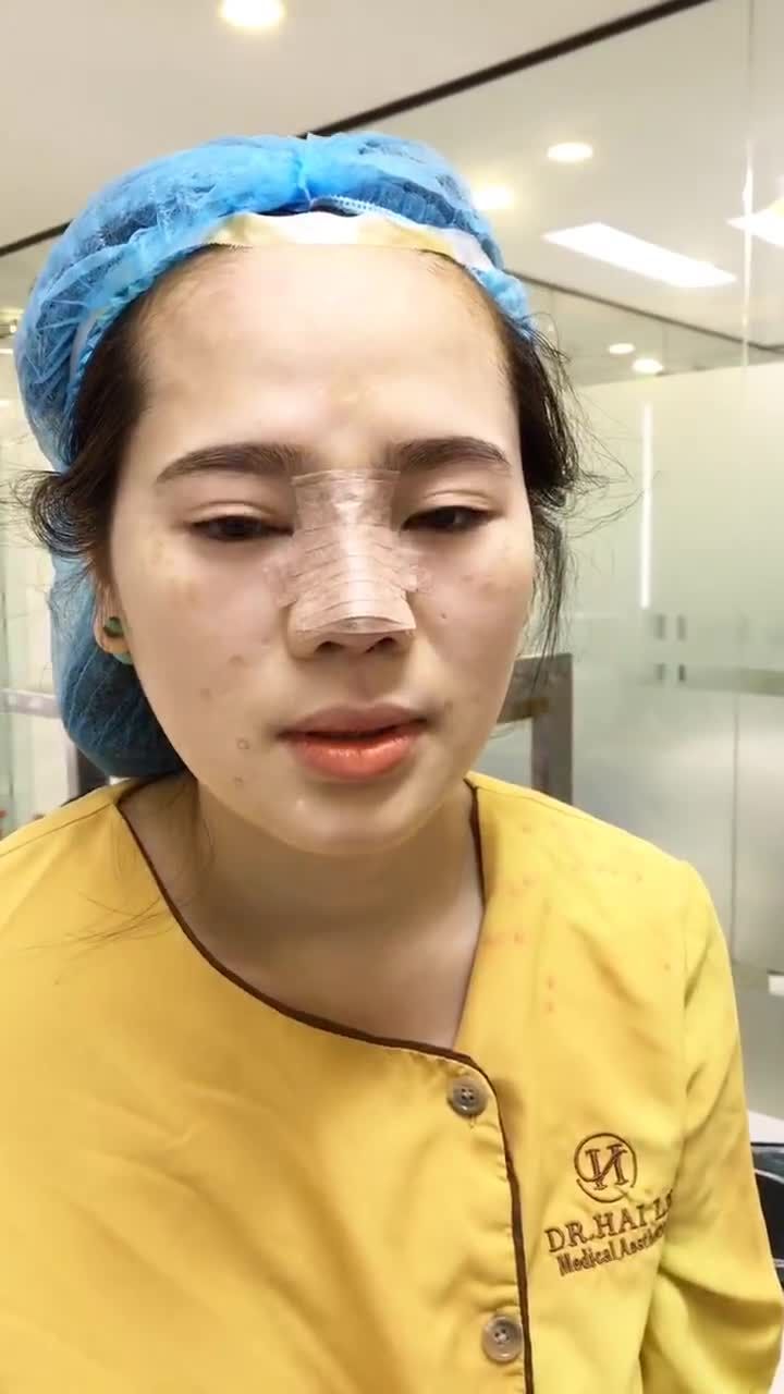 Kết quả sau nâng mũi tại Dr Hải Lê