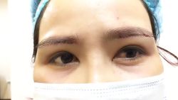 Kết quả nâng cung mày sau khi vừa thực hiện