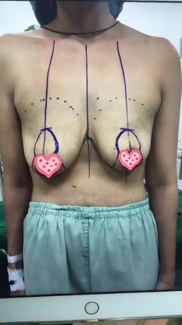 Treo ngực sa trễ cấp độ nặng (cấp độ 4)