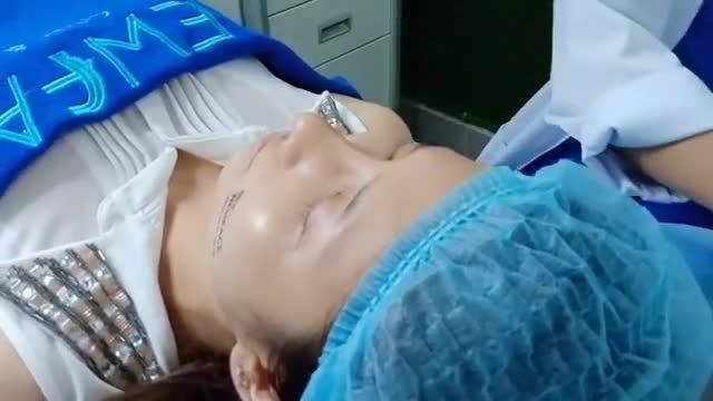 Cận cảnh dáng mũi cấu trúc sau 14 ngày phẫu thuật