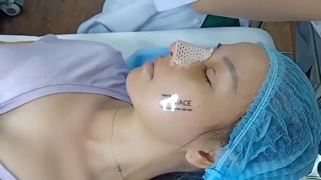 Combo mũi mí được 4 ngày sau PT