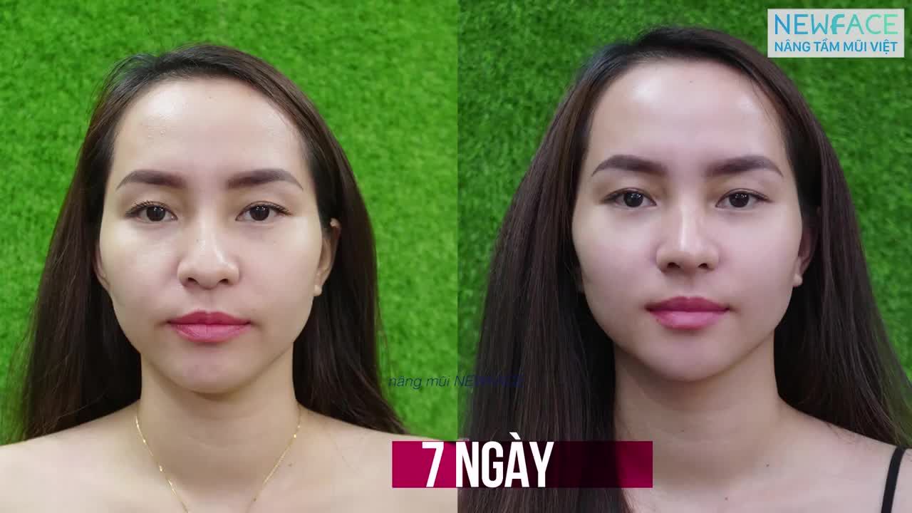 Câu chuyện nâng mũi của bạn Mai Hương (phần 2)