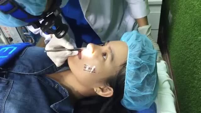 Gặp lại bạn Ngọc Hiều sau 14 nâng mũi cấu trúc nhé các bạn
