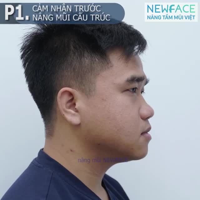 Câu chuyện nâng mũi của bạn Quang Phúc