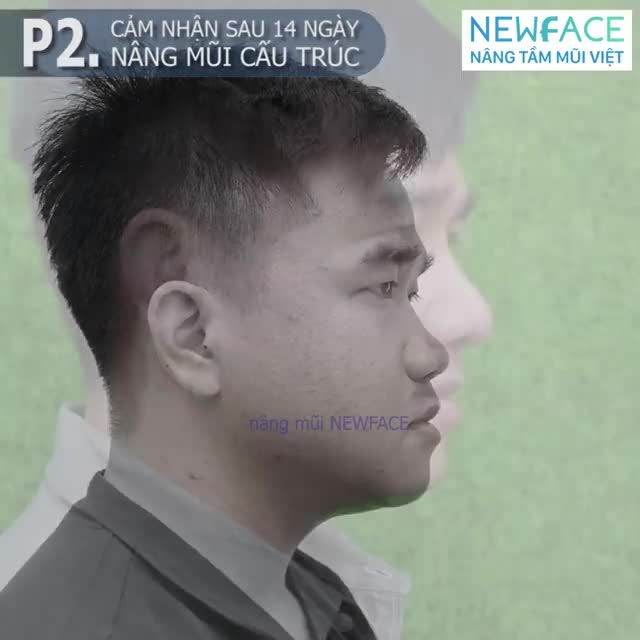 Câu chuyện nâng mũi của bạn Quang Phúc (phần 2)