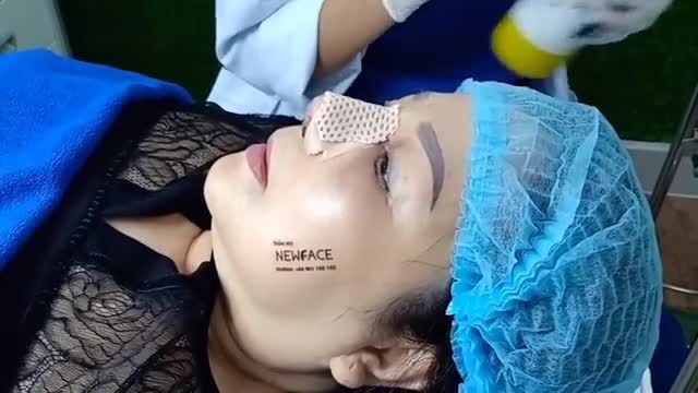 Việt kiều Úc – 1 ngày sau nâng mũi