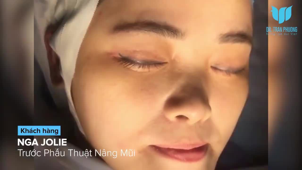 Câu chuyện nâng mũi của bạn Nga Jolie
