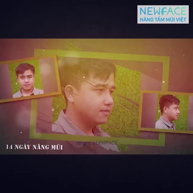 Nâng mũi có phá tướng không?
