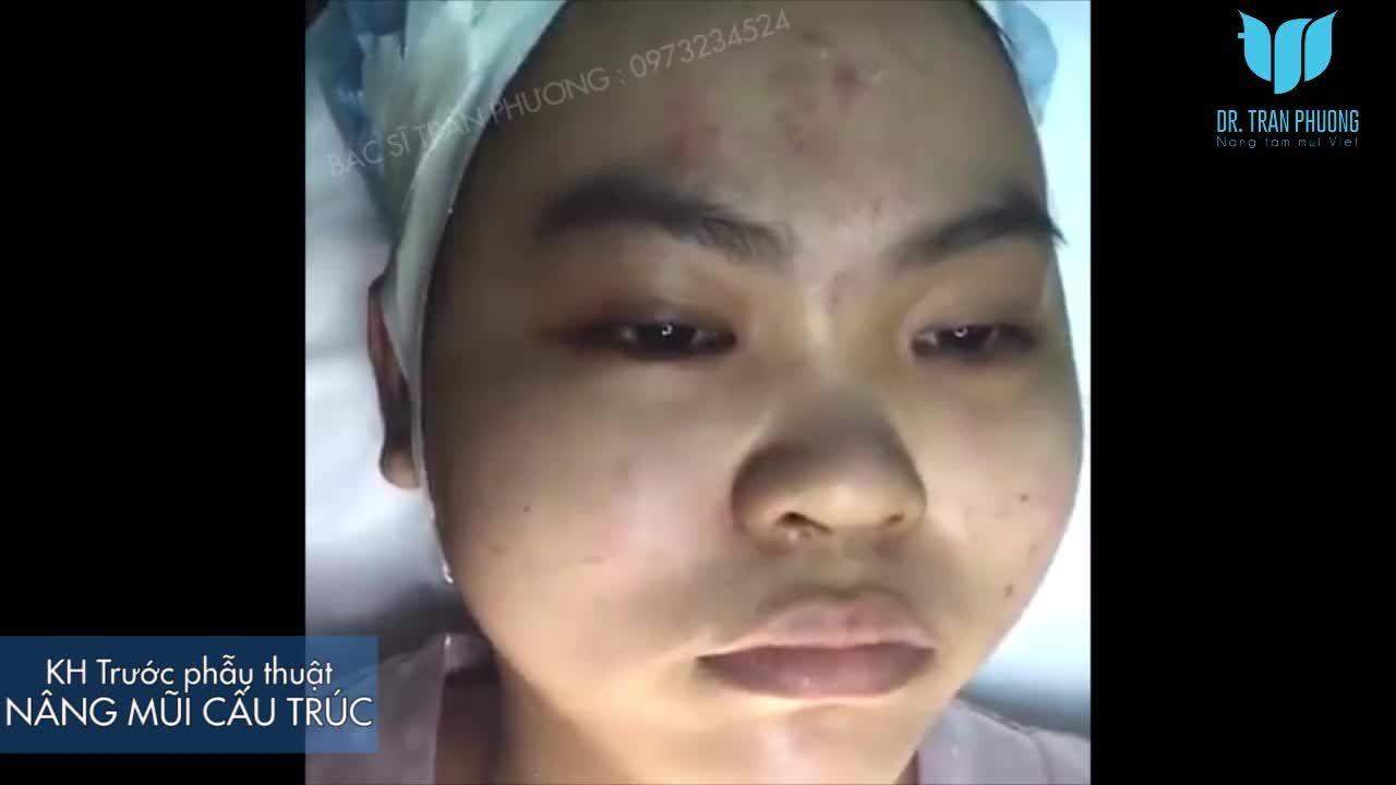 Sự thay đổi bất ngờ sau 60 phút phẫu thuật nâng mũi cấu trúc