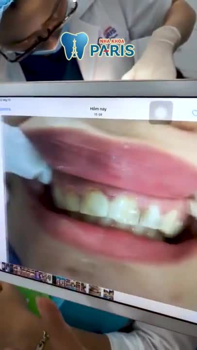 Bọc Răng Sứ Cercon - Làm MỘT lần đẹp MÃI MÃI | Nha khoa Paris