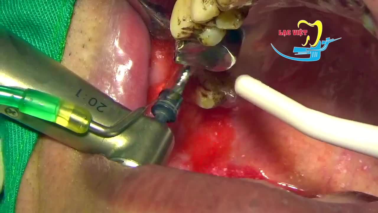 Ca cấy ghép implant răng số 7 hàm trên bên phải - Nha khoa Lạc Việt