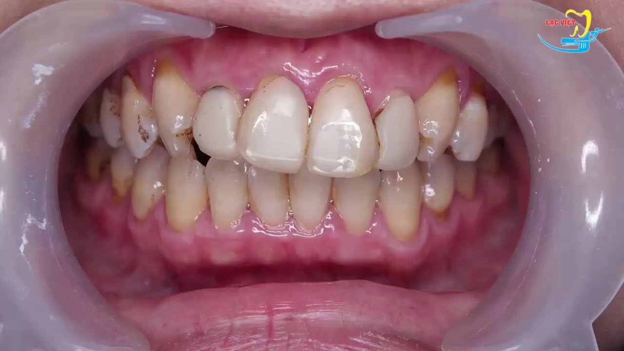 Bọc răng sứ thẩm mỹ tại Nha khoa Lạc Việt
