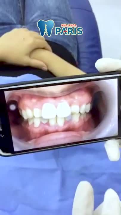 Bọc răng sứ thẩm mỹ - Bền đẹp vĩnh viễn tại Nha khoa Paris