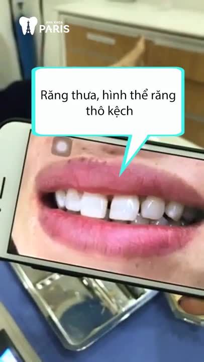 Bọc răng sứ tự nhiên như thật với công nghệ Nano Shining 5S