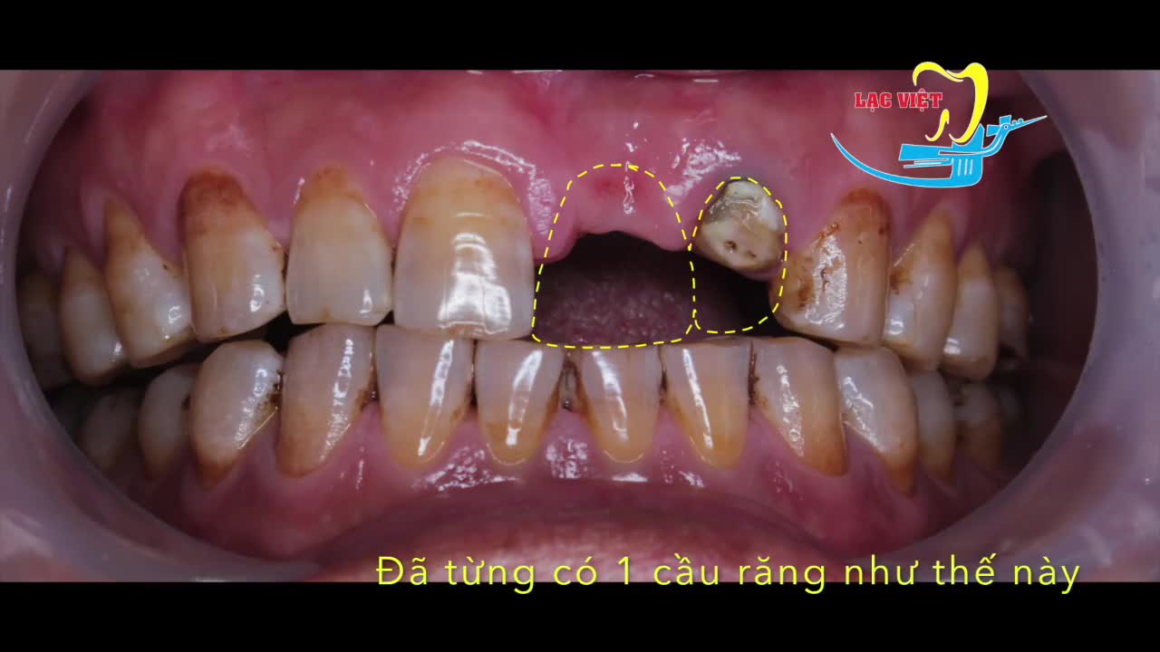 Xử lý ca gẫy răng sứ và trồng răng implant - Nha khoa Lạc Việt