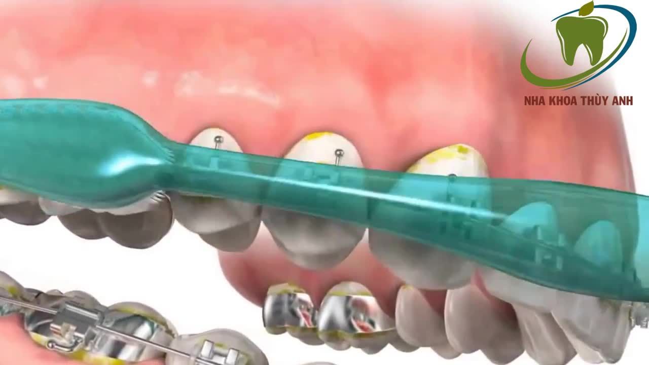 Cách vệ sinh răng miệng đúng khi đang đeo mắc cài trong Chỉnh Nha