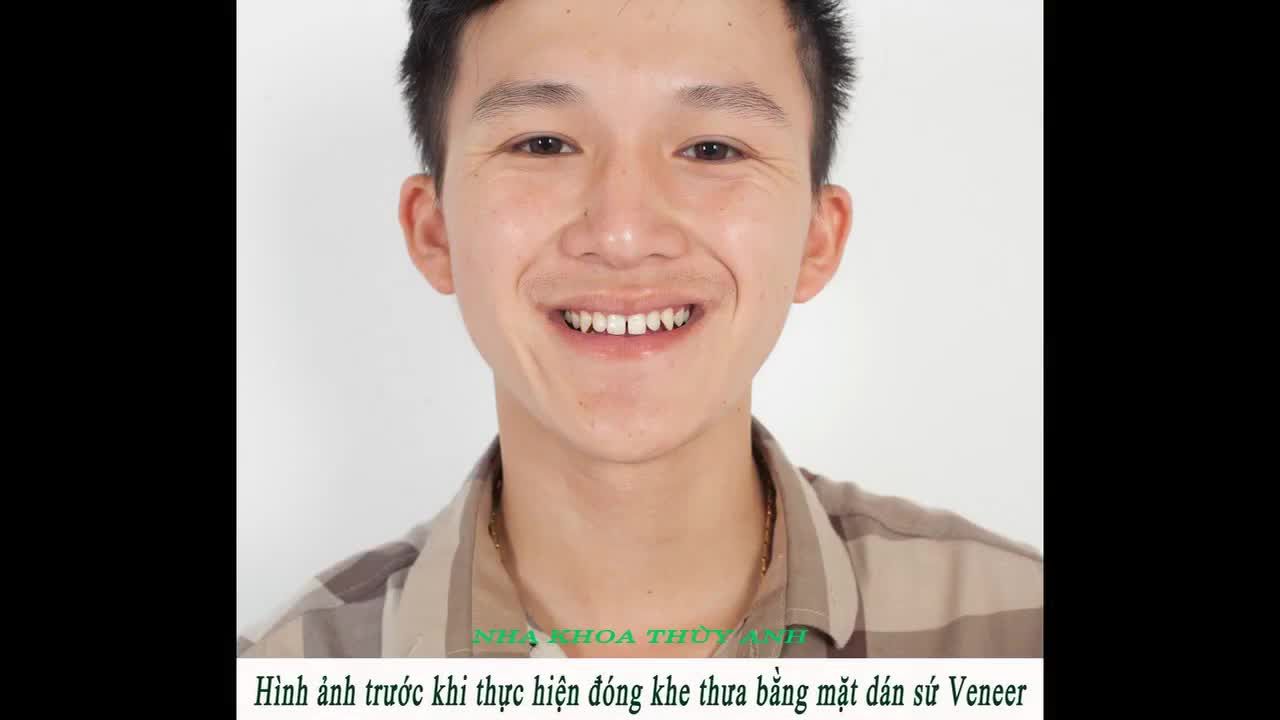 Dán Sứ Veneer tại Nha Khoa Thùy Anh Thái Nguyên