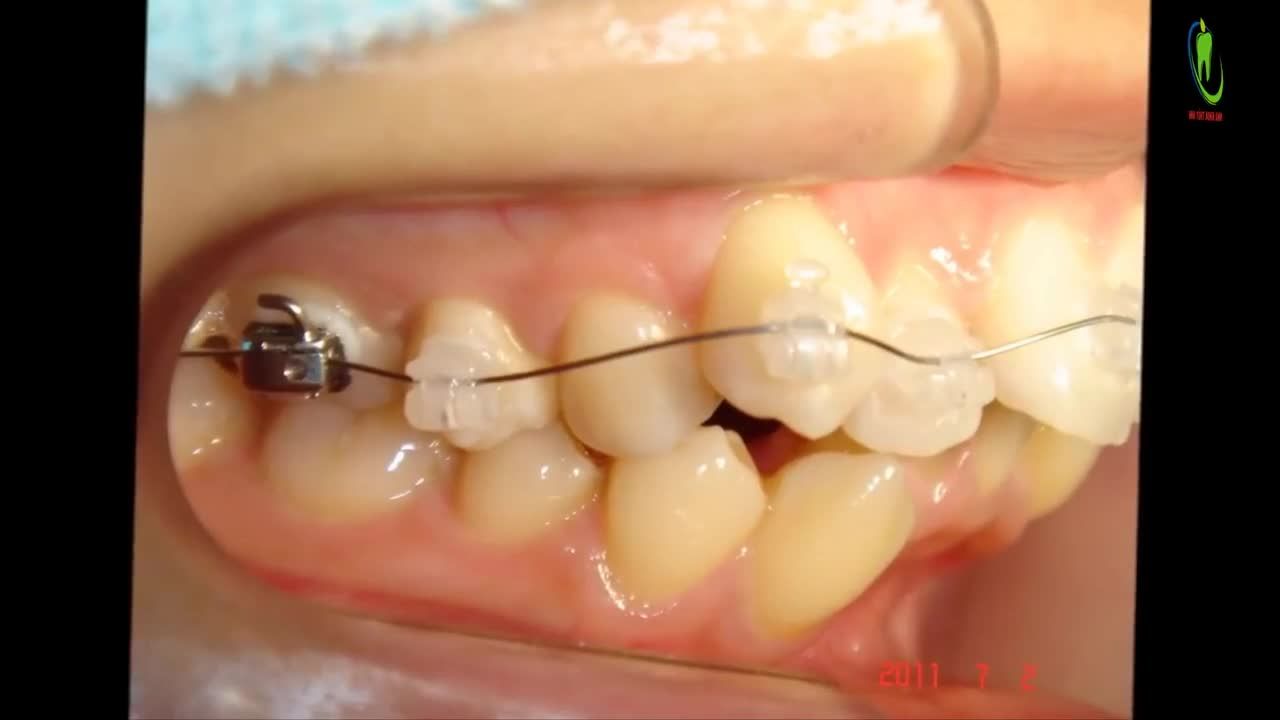 Điều trị chỉnh nha chỉnh sửa răng khấp khểnh