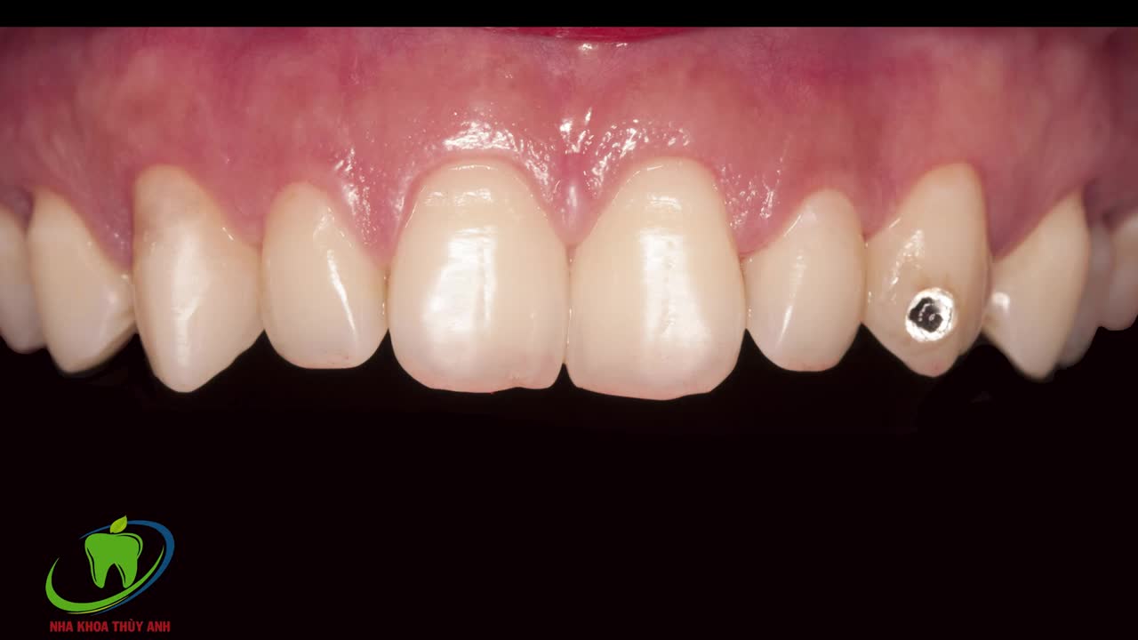 Digital Smile Design - Áp dụng DSD vào Phẫu thuât cười hở lợi