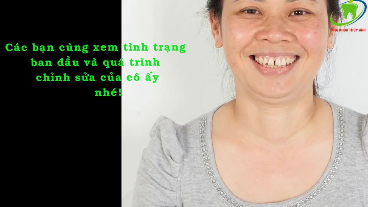 Kết quả khép khe thưa bằng giải pháp dán sứ Veneer tại NHA KHOA THÙY ANH