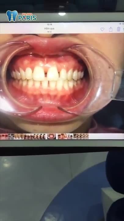 Kết quả niềng răng 3D Speed sau 1 năm tại Nha khoa Paris