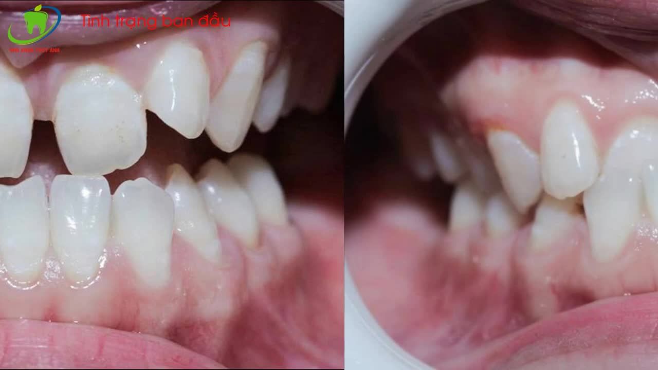 KHẮC PHỤC TÌNH TRẠNG RĂNG THƯA, LỆCH LẠC, KHỚP CẮN NGƯỢC BẰNG PHƯƠNG PHÁP CHỈNH NHA & DÁN SỨ VENEER