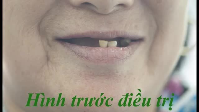 Làm hàm tháo lắp giá rẻ tại Thái nguyên