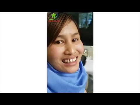 Làm răng sứ sửa khe thưa, vâu tại Nha Khoa Thùy Anh - Thái Nguyên