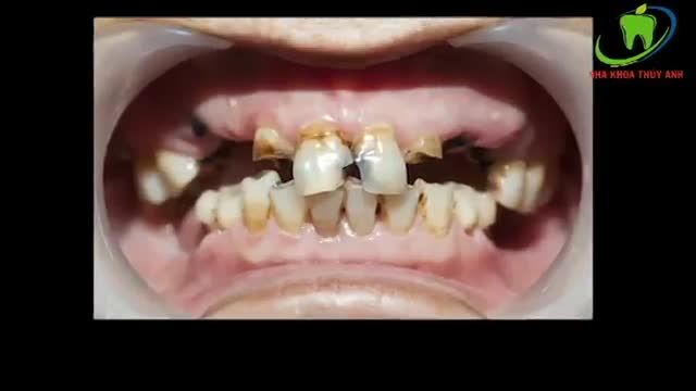 Làm răng sứ thẩm mỹ cho người già tại Nha Khoa Thùy Anh Thái Nguyên