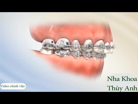 Minh họa điểu trị chỉnh hô tại nha khoa Thùy Anh Thái Nguyên