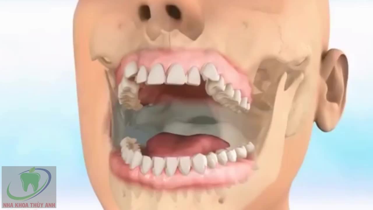 Mô phỏng quá trình Niềng Răng điều trị khớp cắn ngược(móm) - Nha Khoa Thùy Anh