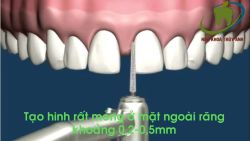 MÔ PHỎNG QUY TRÌNH CHỈNH 2 RĂNG CỦA THƯA BẰNG PHƯƠNG PHÁP DÁN SỨ VENEER