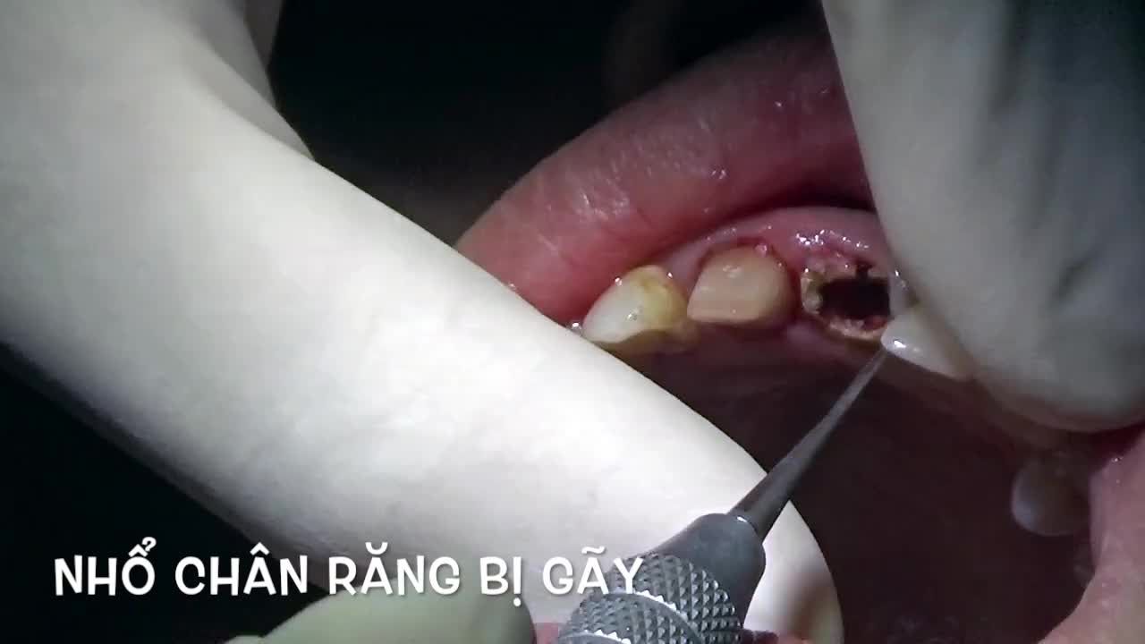 Nhổ răng và đặt implant kết hợp với ghép xương - Nha khoa Lạc Việt