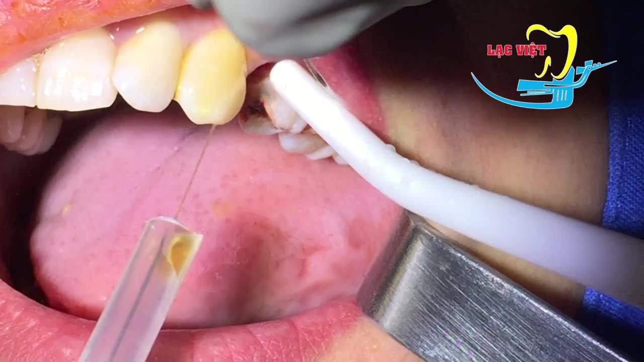 Nhổ và cấy implant tức thì răng 14 - Nha khoa Lạc Việt