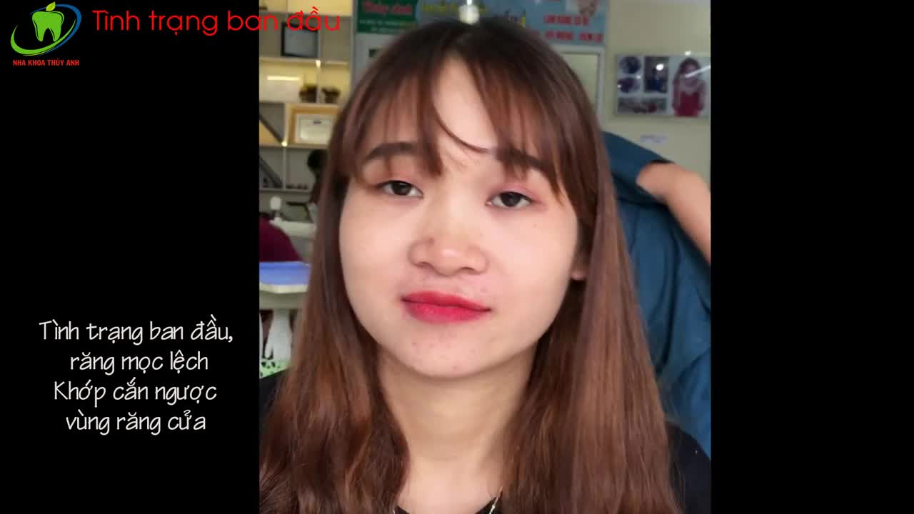 NIỀNG RĂNG ( CHỈNH NHA) KHẮC PHỤC TÌNH TRẠNG RĂNG LỆCH LẠC, KHỚP CẮN NGƯỢC Tại NHA KHOA THÙY ANH