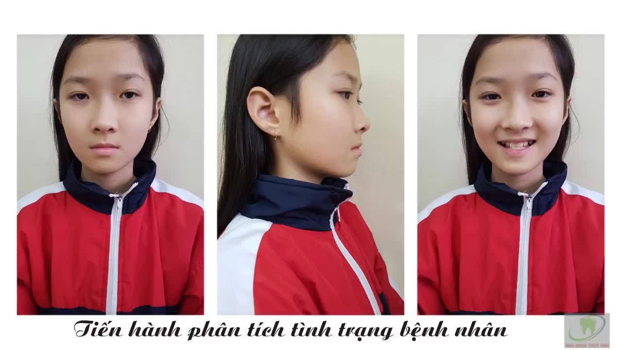 Niềng răng VÂU - LỆCH LẠC - MÓM TRẢ GÓP MỖI THÁNG CHỈ 500K tại Nha Khoa Thùy Anh Thái Nguyên.