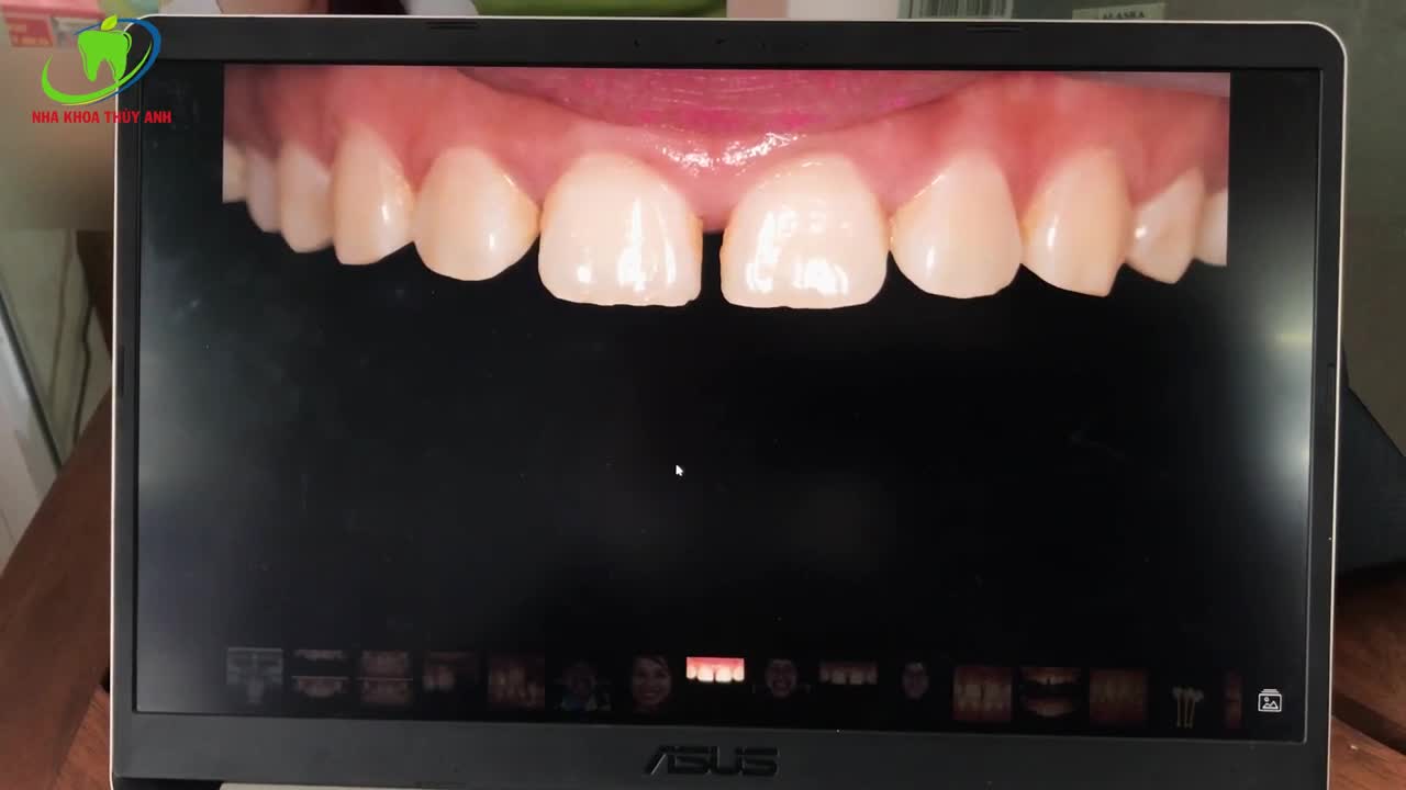 Phân tích ca lâm sàng - Khắc phục khe thưa cho bạn Lê Nga tại Thái Nguyên