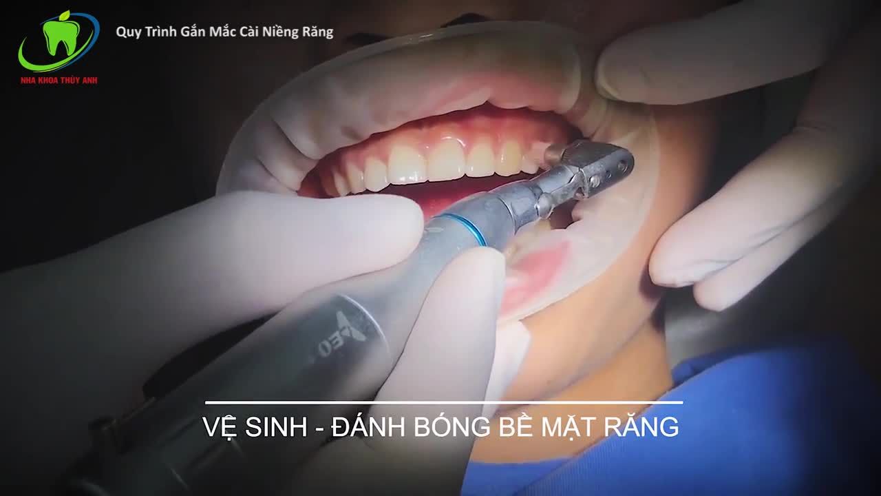 Procedure Show - Quy Trình Gắn Mắc Cài Niềng Răng Sửa Hô Hàm Trên