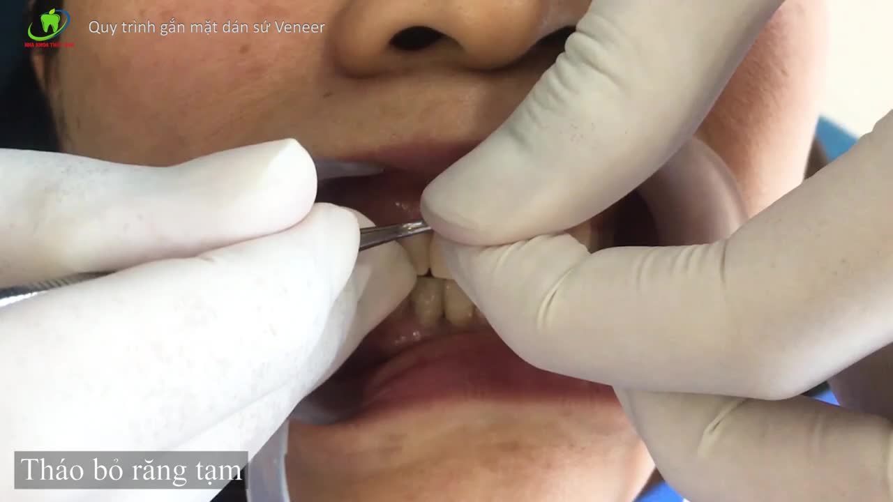 Procedure Show - Quy trình gắn mặt dán sứ Veneer sửa răng thưa