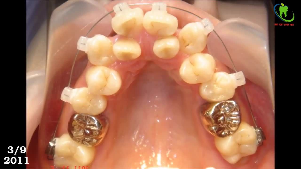 Quá trình tiến triển khi niềng răng ( Mắc cài sứ thẩm mỹ)