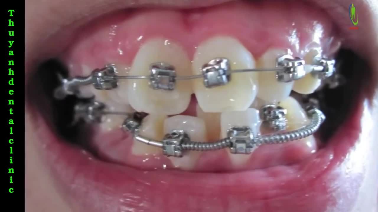 Qúa trình tiến triển trong chỉnh nha ( Niềng Răng)