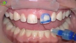 Quy trình dán sứ Veneer không phải mài răng