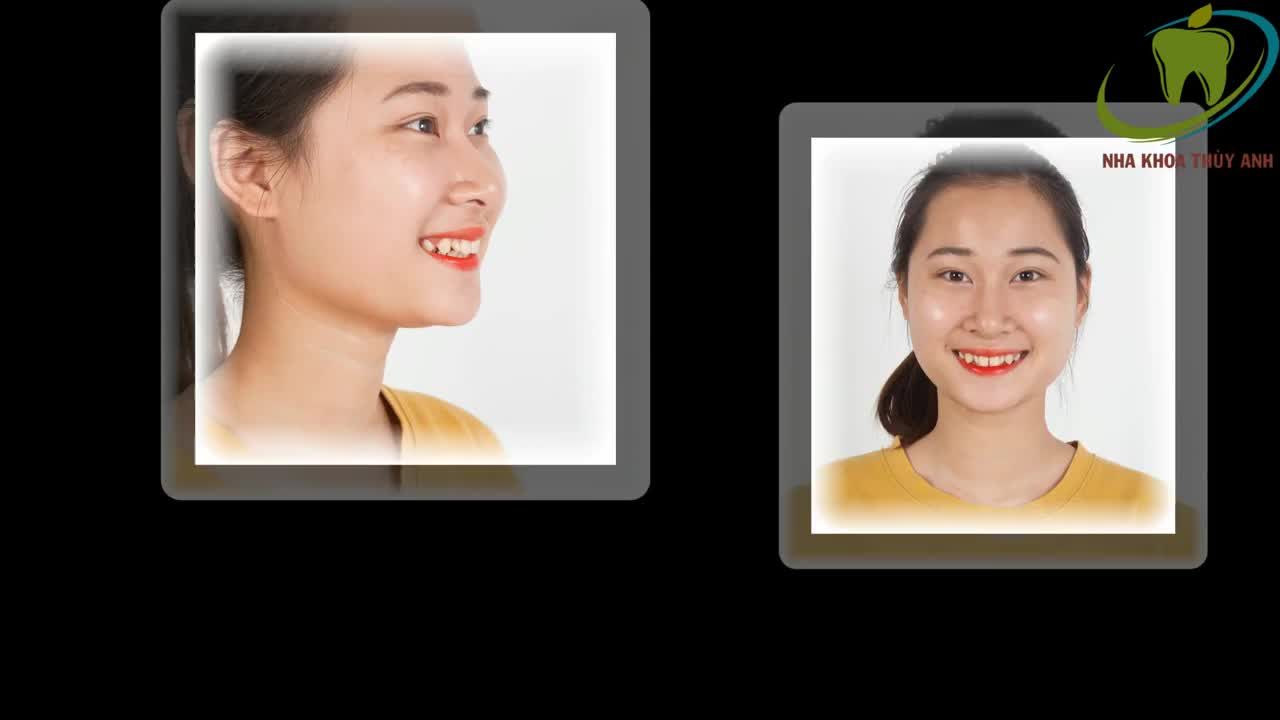 Sử dụng mặt dán sứ VENEER phục hình răng thưa và dị dạng