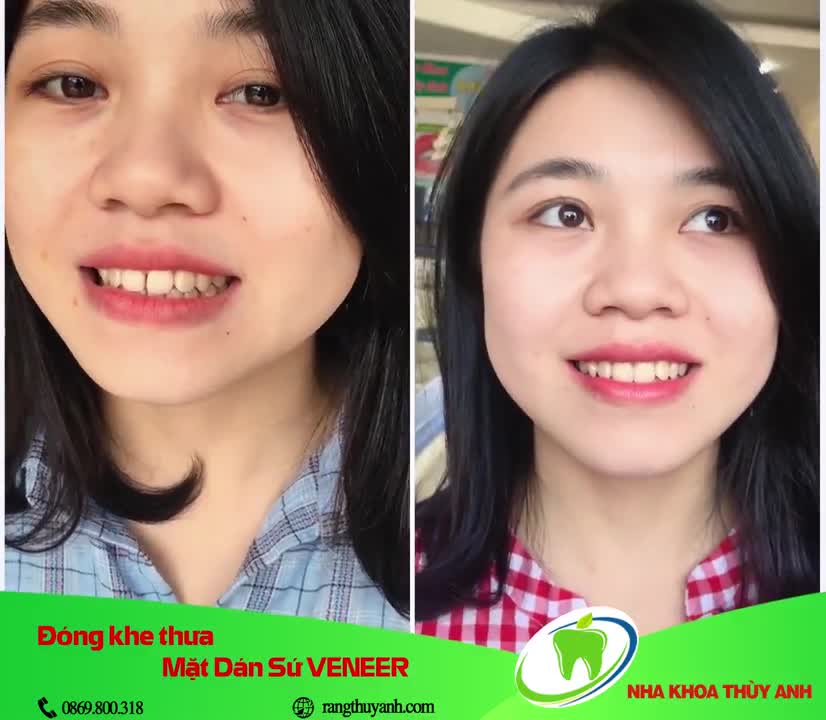 Sửa răng thưa bằng mặt dán sứ Veneer