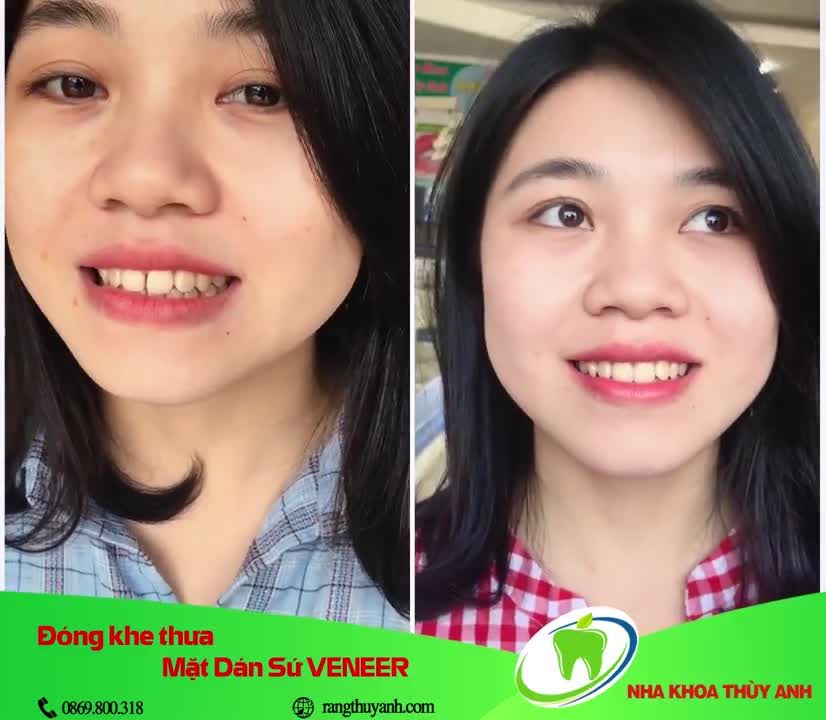 Sửa răng thưa bằng mặt dán sứ Veneer