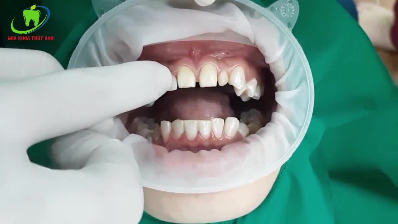 Thay đổi hình thể răng bằng Mặt Sứ Veneer